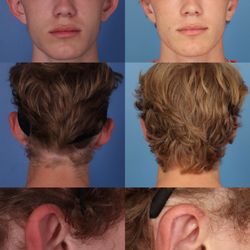 Cameron Francis M.D. - OTOPLASTY