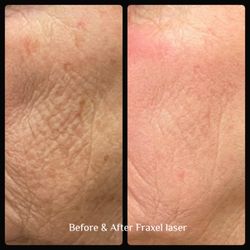 Prestige Cosmetic Dermatology - Before and after Fraxel laser procedure.