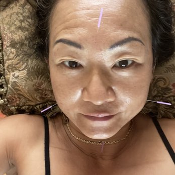 Claremont Skin Care - Fonnie graduated Accupuncuture school after many years of hard working study ! make us younger w eastern medicine technique - Skin Care Near Me - Oakland, California