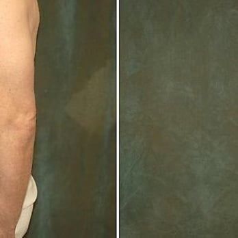 Shlomo Widder, MD - Tummy tuck before and after - Cosmetic Surgeons Near Me - Vienna, Virginia