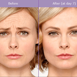 Complexion Med Spa - Botox - Before & After