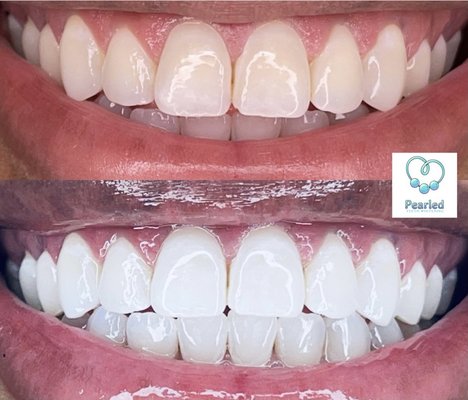 Pearled Teeth Whitening