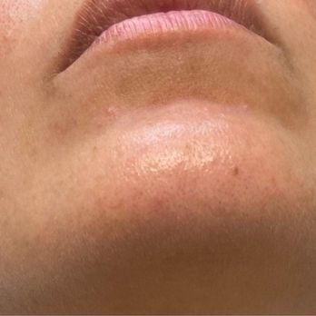 Laser by Nicole - Laser Hair Removal Near Me - Oakland Park, Florida Laser by Nicole - Laser Hair Removal Near Me - Oakland Park, Florida