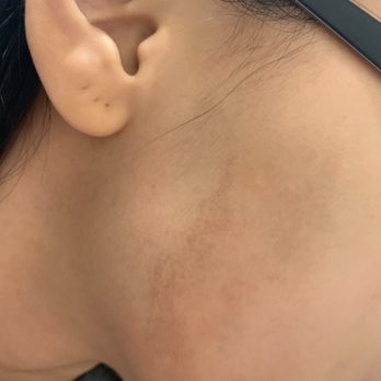 The Face Place - Scars along jawline - Medical Spas Near Me - Hurst, Texas The Face Place - Scars along jawline - Medical Spas Near Me - Hurst, Texas