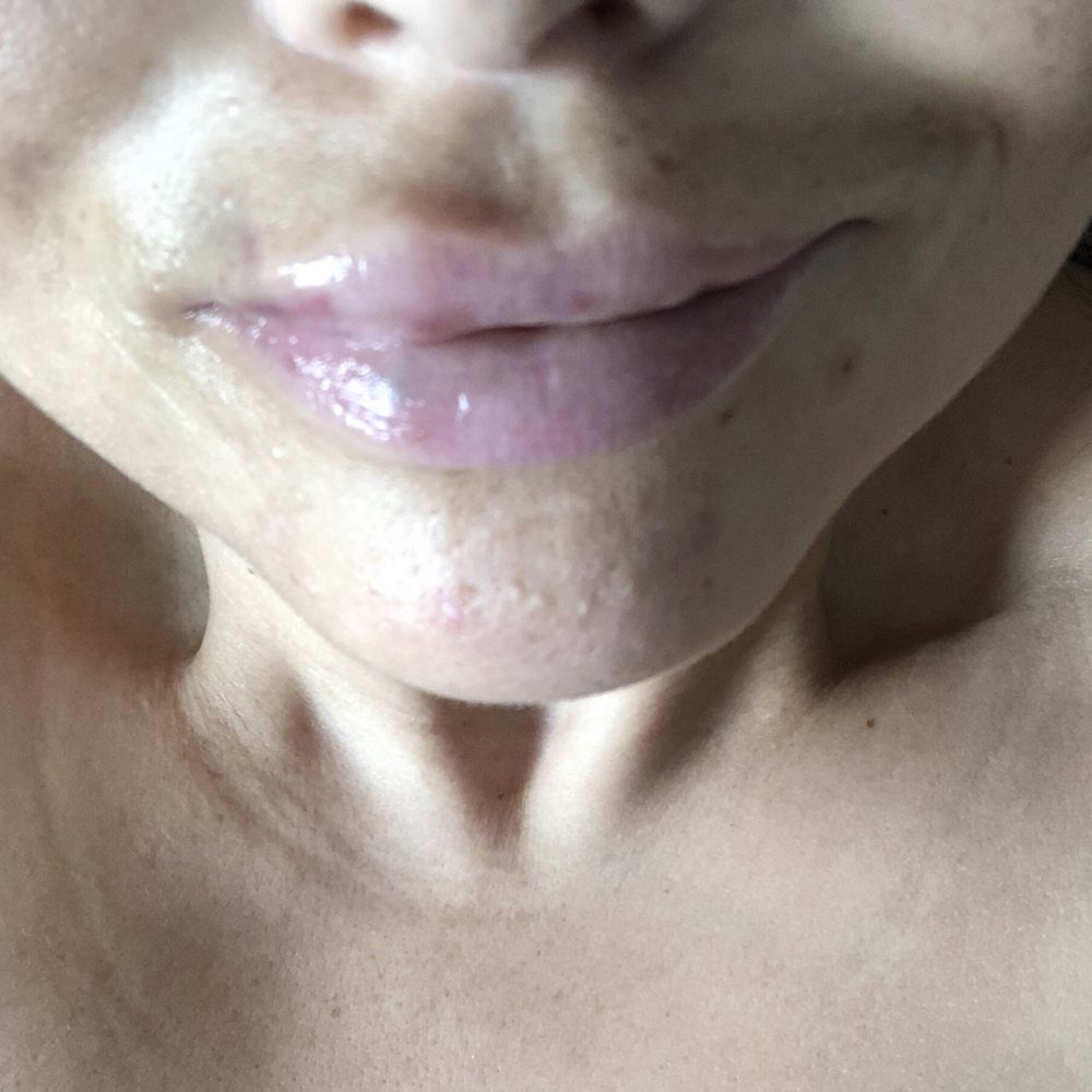Ego - Body Contouring Near Me - Modesto, California