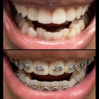 Birmingham Orthodontics - Top: September 1st (right before braces were installed) Bottom: December 3rd (three months of treatment) - Orthodontists Near Me - Hoover, Alabama Birmingham Orthodontics - Top: September 1st (right before braces were installed) Bottom: December 3rd (three months of treatment) - Orthodontists Near Me - Hoover, Alabama