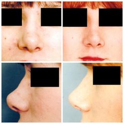 Craig R. Dufresne, MD, FACS - 25-34 year old woman treated with Rhinoplasty (Nose Surgery)