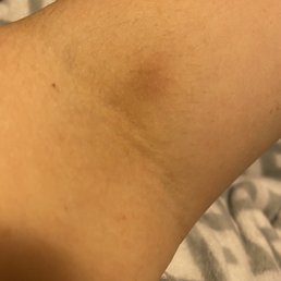 Bruise from blood draw after tech was digging the needle under my skin.