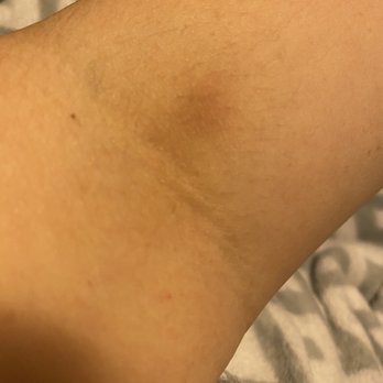 Quest Diagnostics - Bruise from blood draw after tech was digging the needle under my skin. - Laboratory Testing Near Me - Silver Spring, Maryland