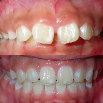Jenela Chow, DMD - Actual patient case: Mouth breathing can lead to malocclusion - General Dentistry Near Me - San Francisco, California Jenela Chow, DMD - Actual patient case: Mouth breathing can lead to malocclusion - General Dentistry Near Me - San Francisco, California