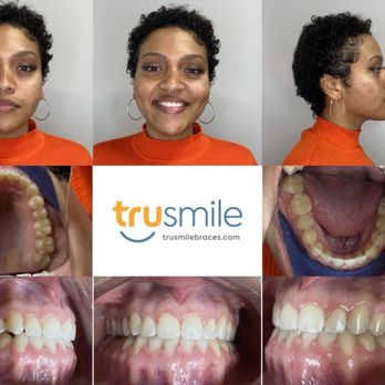 TruSmile Orthodontics - Afters 2 years - Orthodontists Near Me - Culver City, California TruSmile Orthodontics - Afters 2 years - Orthodontists Near Me - Culver City, California