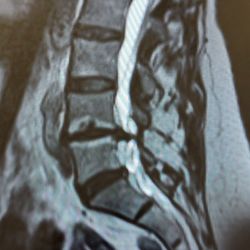 Tiffany Rogers, MD, MPT - Shows how severe the herniation was