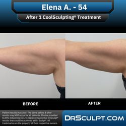 Dr. Sculpt CoolSculpting & EmSculpt Center - After 1 CoolSculpting treatment on arms