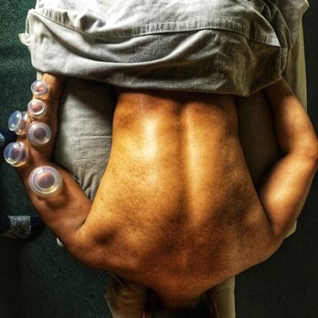 Vincent Carbaugh Massagetherapy - Cupping Therapy for Golfer's Elbow. - Massage Therapy Near Me - Long Beach, California Vincent Carbaugh Massagetherapy - Cupping Therapy for Golfer's Elbow. - Massage Therapy Near Me - Long Beach, California