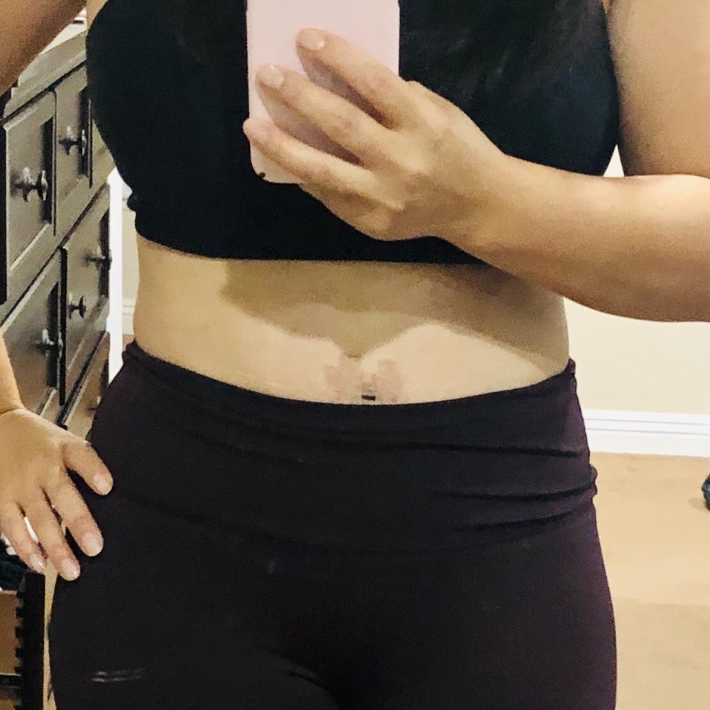 Post Op 4 wks recovery. I'm loving my new body. Post Op 4 wks recovery. I'm loving my new body.
