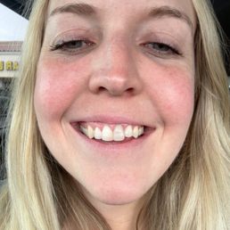 Before - my front tooth was turning grey because the nerve had died Before - my front tooth was turning grey because the nerve had died