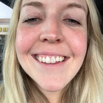 Sunset Dental & Orthodontics - Before - my front tooth was turning grey because the nerve had died - Orthodontists Near Me - Henderson, Nevada Sunset Dental & Orthodontics - Before - my front tooth was turning grey because the nerve had died - Orthodontists Near Me - Henderson, Nevada
