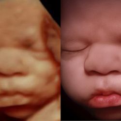 A Little Insight 3D 4D 5D Ultrasound