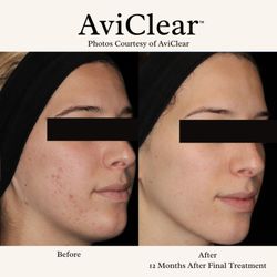 Spa Aesthetica Medical Spa & Wellness Center - AviClear: FDA-cleared laser for mild to severe acne. Targets sebaceous glands, drug-free with no downtime. Effective for all skin types.