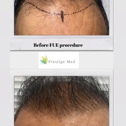 Prestige Med - FUE hair transplant. 1st procedure. 3000 grafts.