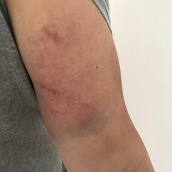 Bay Breeze Charters - Injury from Pam's boat ride. - Boating Near Me - Sausalito, California