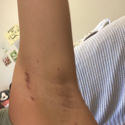 Brazilian Wax and Spa by Claudia - bruised underarm.
