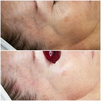 Balance Esthetics - Anti-aging facial - Skin Care Near Me - Norco, California