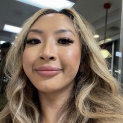Ariba Medical Spa - Results a few days after cheek & chin filler