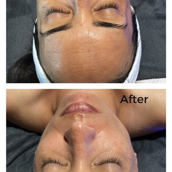 Dermacation Skin Retreat - Before and after from one facial treatment - Skin Care Near Me - Santa Ana, California Dermacation Skin Retreat - Before and after from one facial treatment - Skin Care Near Me - Santa Ana, California