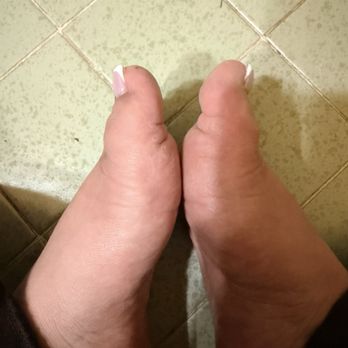 Nail Addict - Swollen toe - Nail Salons Near Me - Los Angeles, California Nail Addict - Swollen toe - Nail Salons Near Me - Los Angeles, California