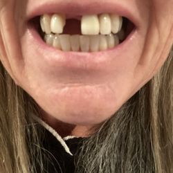 San Mateo Dental Arts - This is post surgery (showing you my two options for over 5 weeks?