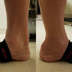 Seong Yoo, DPM - Left Achilles tendon rupture, I tend to opt for surgery if you are active.