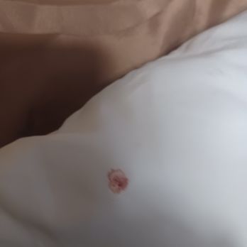 Quality Inn Albertville Us 431 - Blood on pillow case - Hotels Near Me - Albertville, Alabama Quality Inn Albertville Us 431 - Blood on pillow case - Hotels Near Me - Albertville, Alabama