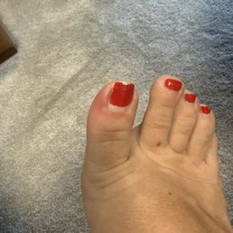 Infected toe from pedicure. You can see where the nail lady cut out the side of my nail. Infected toe from pedicure. You can see where the nail lady cut out the side of my nail.