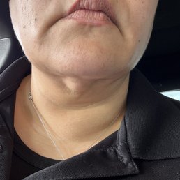 Chin lipo literally forget the whole center of the chin was told by doctor Mann that it's just fluid 8 months later it's still there! Chin lipo literally forget the whole center of the chin was told by doctor Mann that it's just fluid 8 months later it's still there!