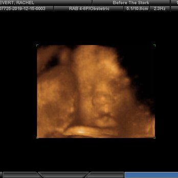 Before the Stork 4D - 3D ultrasound at 27 weeks - Ultrasound Imaging Centers Near Me - Anaheim, California Before the Stork 4D - 3D ultrasound at 27 weeks - Ultrasound Imaging Centers Near Me - Anaheim, California