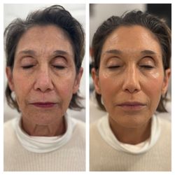 NovaGen Skin & Wellness - PDO Thread lift