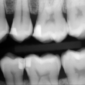 Siuman Fan, DDS - X-ray filling - General Dentistry Near Me - San Diego, California Siuman Fan, DDS - X-ray filling - General Dentistry Near Me - San Diego, California