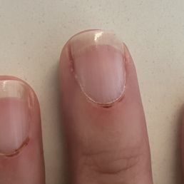Damaged cuticles
