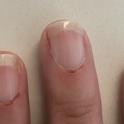 Damaged cuticles