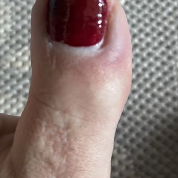 Queen Nails Spa - Cut my toe and infected red area on the right. - Nail Salons Near Me - Melbourne, Florida