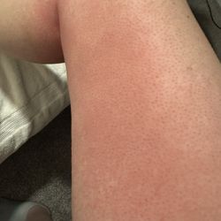 Radiant Waxing Riverdale - More hives.