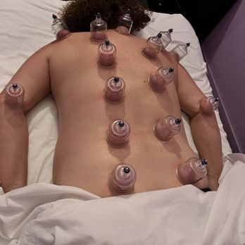 Vital Day Spa - Cupping therapy - Massage Near Me - San Leandro, California