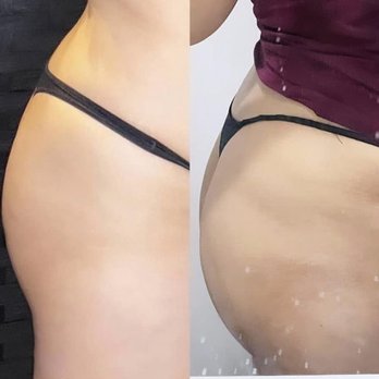 Matsunaga Loves - 30 day results from bbl gummies ! - Body Contouring Near Me - Milpitas, California Matsunaga Loves - 30 day results from bbl gummies ! - Body Contouring Near Me - Milpitas, California