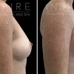 Drew Schnitt, MD - Breast Augmentation Before & After