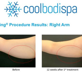 Coolbodispa - Female client 12 weeks after one Coolsculpting® treatment to her arms. - Body Contouring Near Me - Norman, Oklahoma