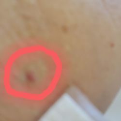 Mellman Medical - Angie drew my blood today and this is what you see on my arm - a tiny pinprick, not the huge bruise I normally get. Thank you, Angie.