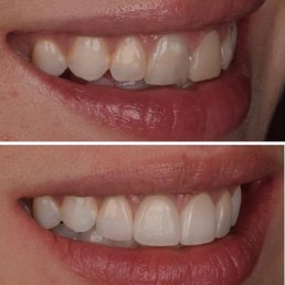 Veneers Veneers