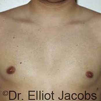 Elliot W. Jacobs, MD - Cosmetic Surgeons Near Me - Boca Raton, Florida Elliot W. Jacobs, MD - Cosmetic Surgeons Near Me - Boca Raton, Florida