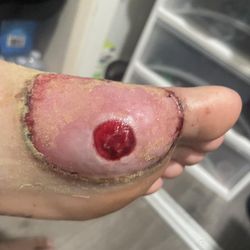 Ben Wehrli DPM - I bleeding didn't stop for about 3 weeks. I'm not sure what nerve got damaged, but the bleeding didn't stop for awhile